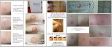 SKINFOOD 1+1 Big Sale Trouble Clear Spot Patch (24patches)x 2Sheets [スキンフード]トラブルクリアスポットパッチ(24パッチ） (1+1(24Patch x2)) [並行輸入品]