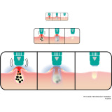 Me Clear Spot Treatment Device for Blemish - Prone Skin